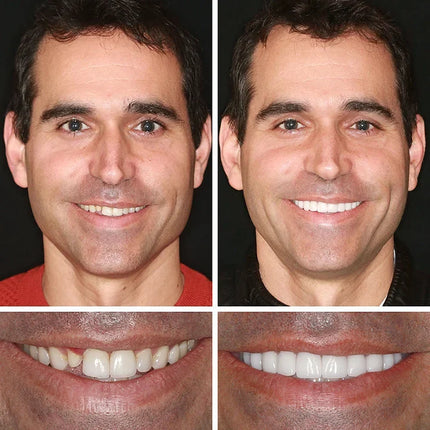 Full Dentures, Upper and Lower Flexible Dentures – image 10