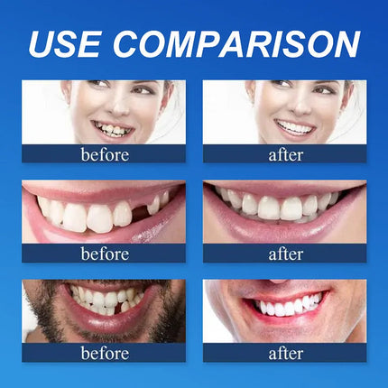 Upper and Lower Flexible Dentures – image 15