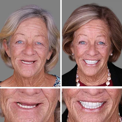 Full Dentures, False Teeth – image 13