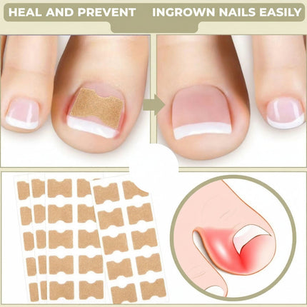 Ingrown Toenail Correction Patches for Healthy Nail Growth | Comfortable Non-Invasive Support for Daily Wear