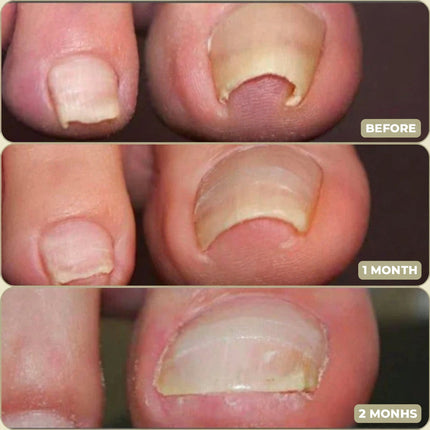 Ingrown Toenail Correction Patches for Healthy Nail Growth | Comfortable Non-Invasive Support for Daily Wear