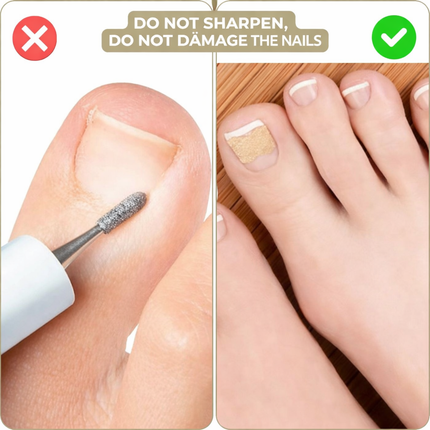 Ingrown Toenail Correction Patches for Healthy Nail Growth | Comfortable Non-Invasive Support for Daily Wear