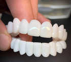 Dental Veneers, Snap On Veneers for a Natural Smile, Removable Teeth Veneers to Hide Stains and Imperfections