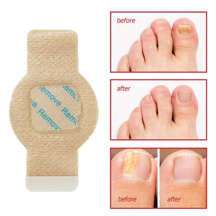 Antifungal Nail Treatment – image 5