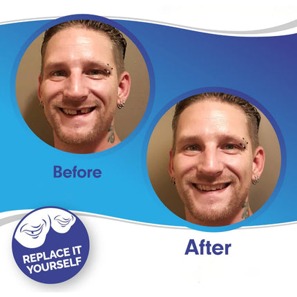 Teeth Veneer Cosmetic Cover Set with Custom Fit | Smile Enhancement for Gaps and Stains