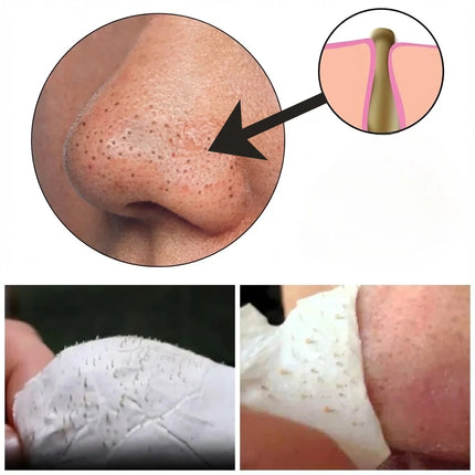 Blackhead Remover Strip Kit, Cleansing Cream with 60 Lifting Strips, 10-Minute No-Squeeze Nose and Face Pore Cleaning