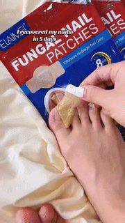 Fungal Nail Patches for Toenails and Fingernails
