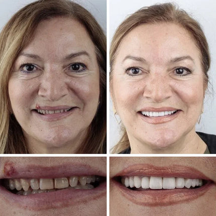 Full Dentures, Fake Teeth Replacement – image 12
