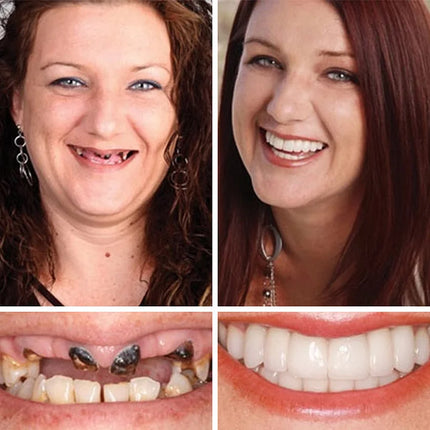 Full Dentures, DIY Dentures Custom Fit – image 11