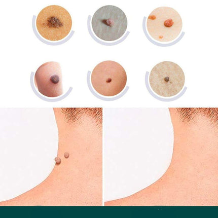 Hydrocolloid Skin Tag Remover Patches for Clear Skin | 120 Adhesive Spot Treatments for Targeted Care