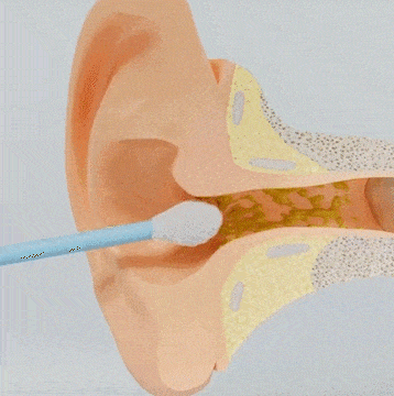 Spiral Ear Cleaner Tool with Gentle Silicone Tips | Safe & Effective Ear Wax Removal