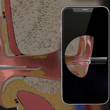 Ear Cleaner with HD Camera | Wireless Design for Safe, Effective Cleaning